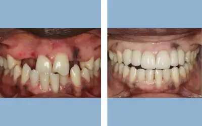 Before and After